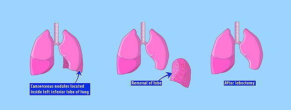 dmg pulmonary